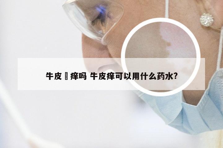 牛皮廯痒吗 牛皮痒可以用什么药水?