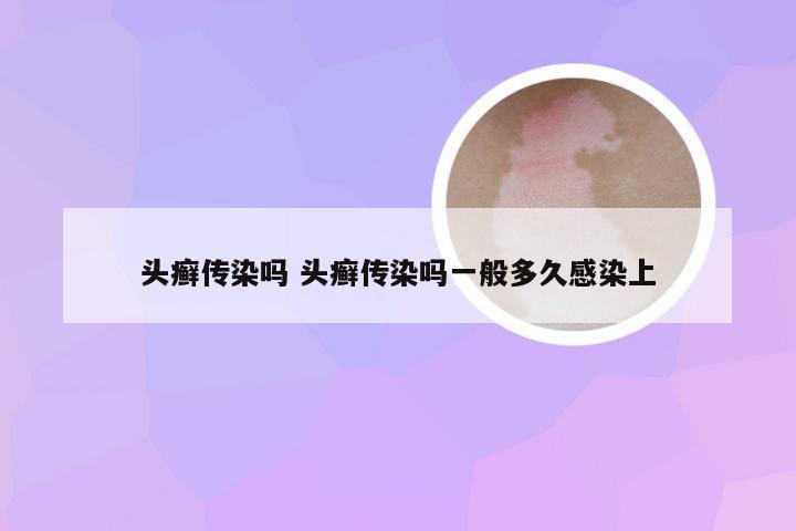 头癣传染吗 头癣传染吗一般多久感染上