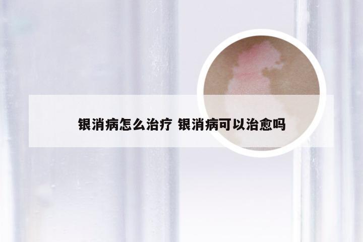 银消病怎么治疗 银消病可以治愈吗