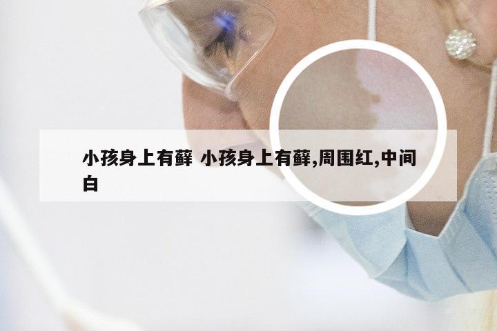 小孩身上有藓 小孩身上有藓,周围红,中间白