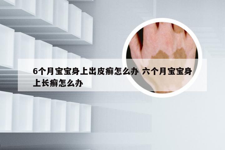 6个月宝宝身上出皮癣怎么办 六个月宝宝身上长癣怎么办