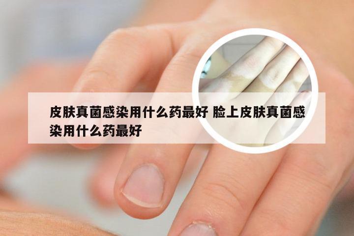 皮肤真菌感染用什么药最好 脸上皮肤真菌感染用什么药最好