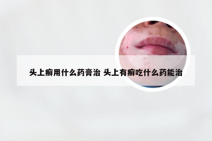 头上癣用什么药膏治 头上有癣吃什么药能治