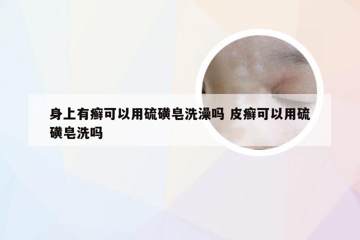 身上有癣可以用硫磺皂洗澡吗 皮癣可以用硫磺皂洗吗