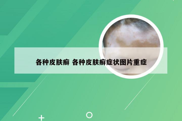 各种皮肤癣 各种皮肤癣症状图片重症