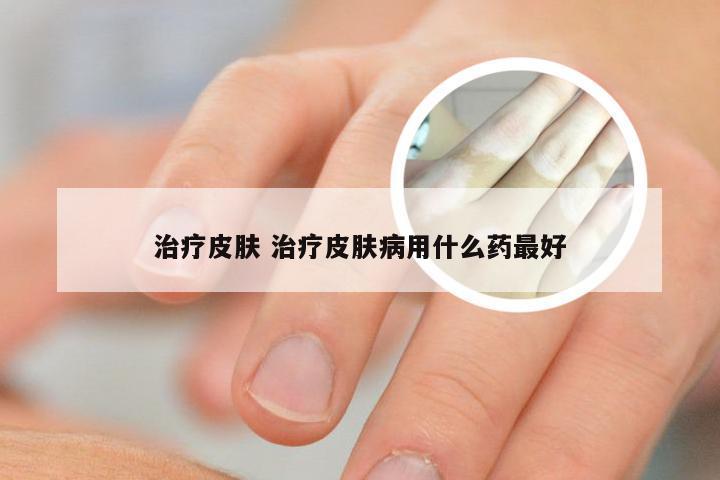 治疗皮肤 治疗皮肤病用什么药最好