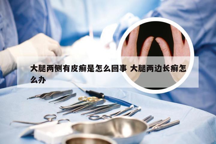 大腿两侧有皮癣是怎么回事 大腿两边长癣怎么办