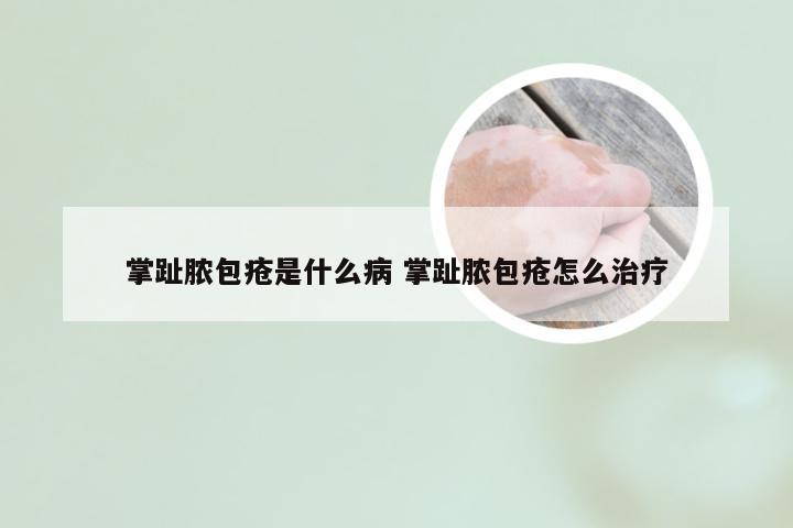 掌趾脓包疮是什么病 掌趾脓包疮怎么治疗