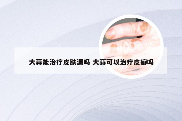 大蒜能治疗皮肤漏吗 大蒜可以治疗皮癣吗