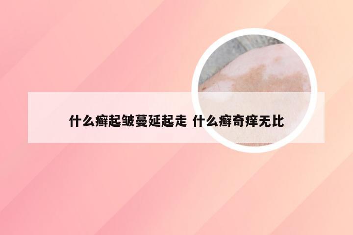 什么癣起皱蔓延起走 什么癣奇痒无比