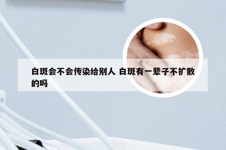 白斑会不会传染给别人 白斑有一辈子不扩散的吗