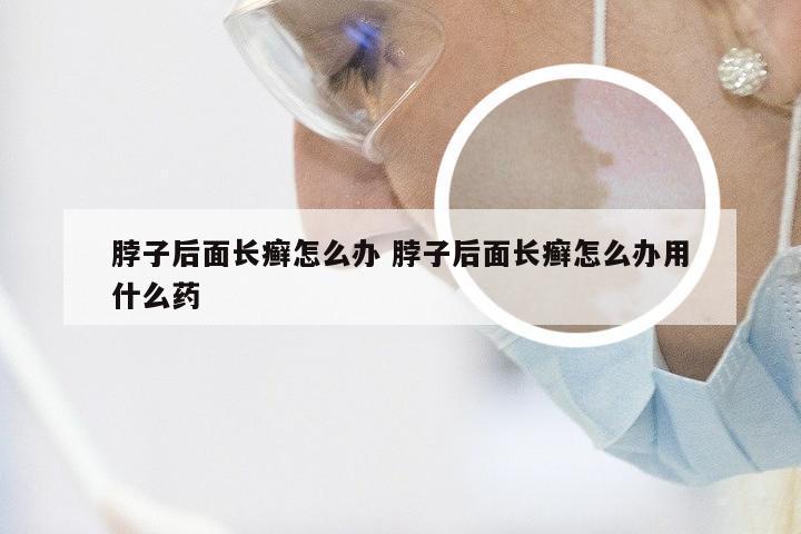 脖子后面长癣怎么办 脖子后面长癣怎么办用什么药