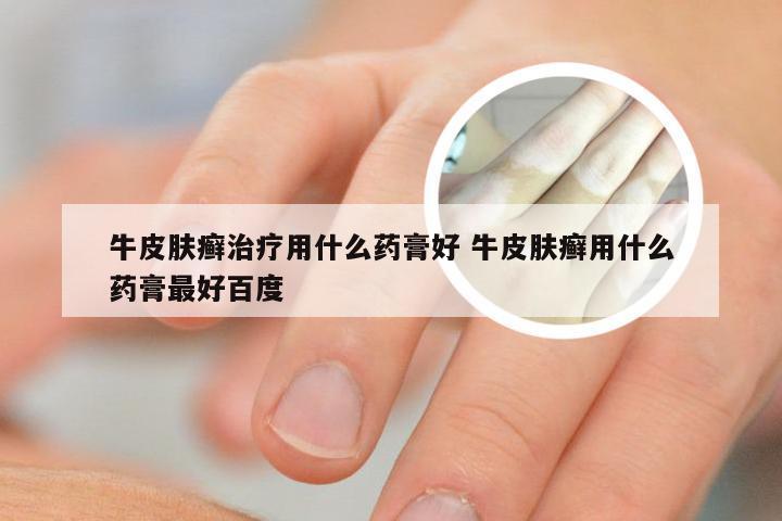 牛皮肤癣治疗用什么药膏好 牛皮肤癣用什么药膏最好百度