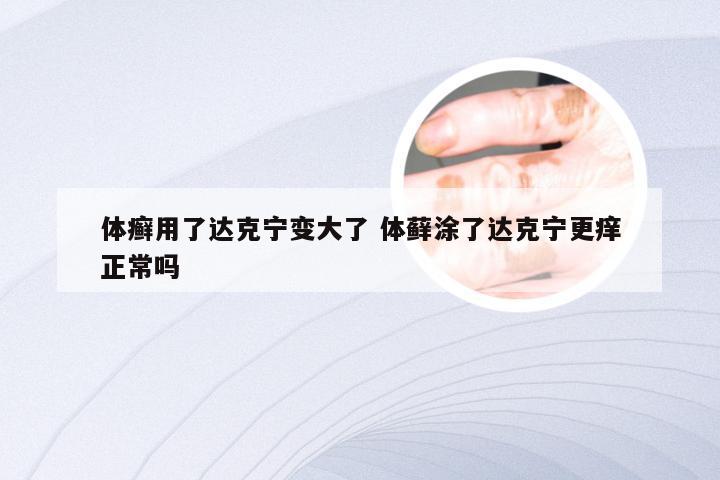 体癣用了达克宁变大了 体藓涂了达克宁更痒正常吗