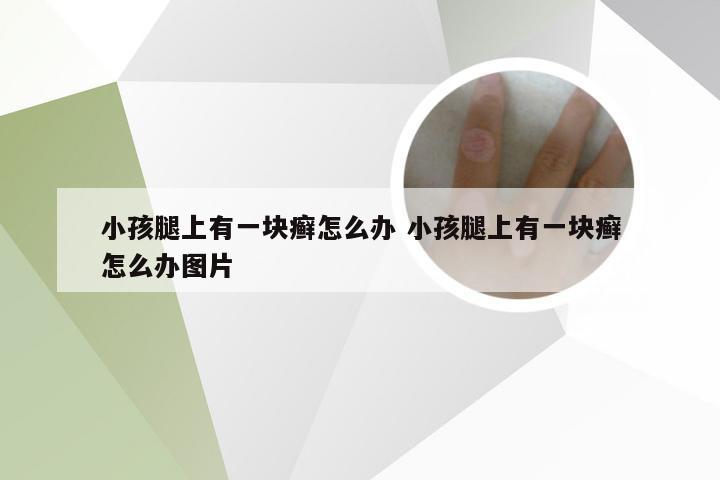 小孩腿上有一块癣怎么办 小孩腿上有一块癣怎么办图片