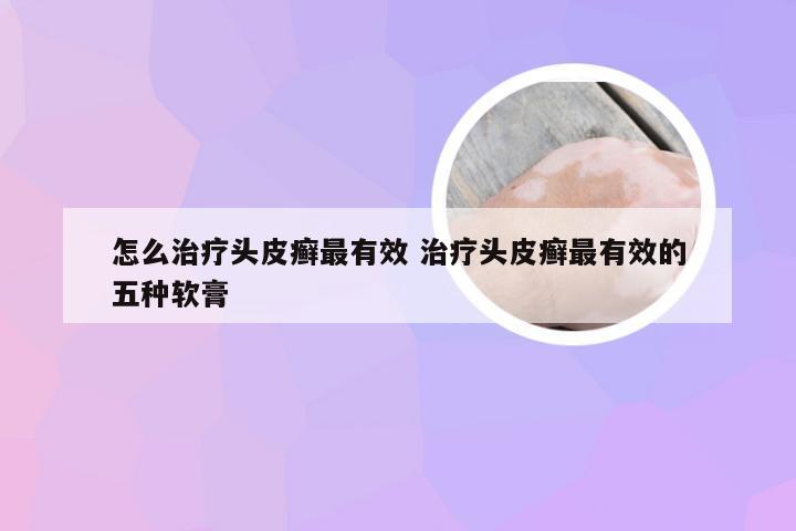 怎么治疗头皮癣最有效 治疗头皮癣最有效的五种软膏