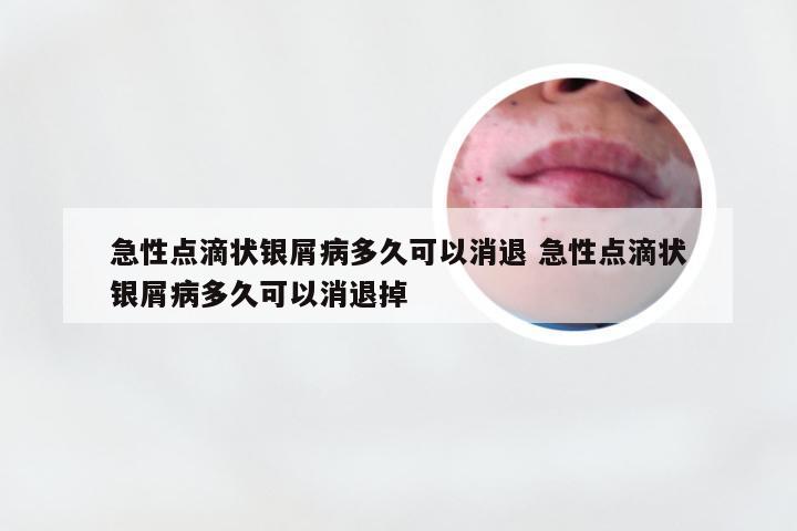 急性点滴状银屑病多久可以消退 急性点滴状银屑病多久可以消退掉