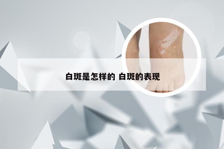 白斑是怎样的 白斑的表现