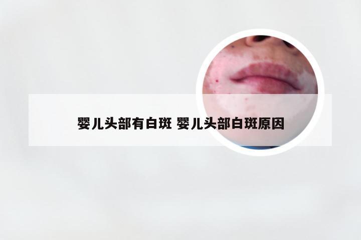 婴儿头部有白斑 婴儿头部白斑原因