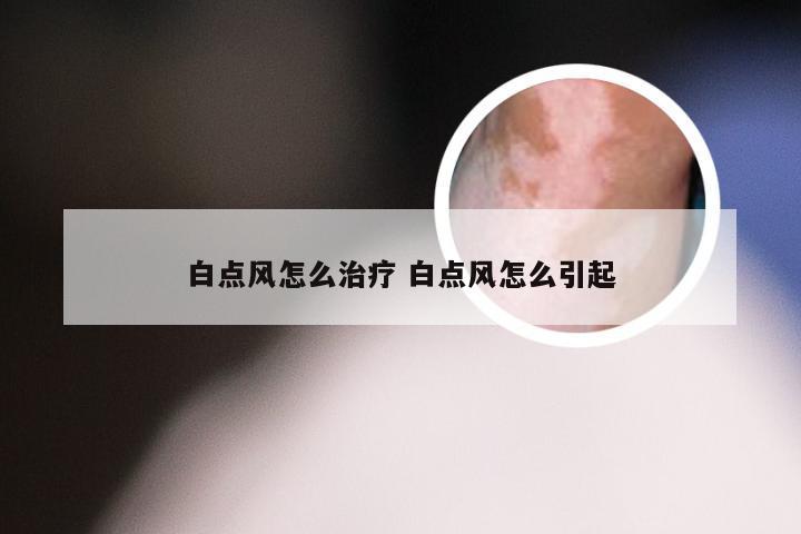 白点风怎么治疗 白点风怎么引起