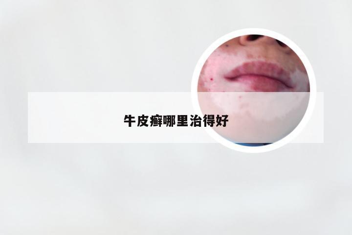 牛皮癣哪里治得好