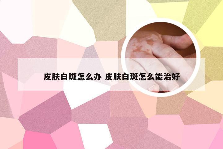 皮肤白斑怎么办 皮肤白斑怎么能治好