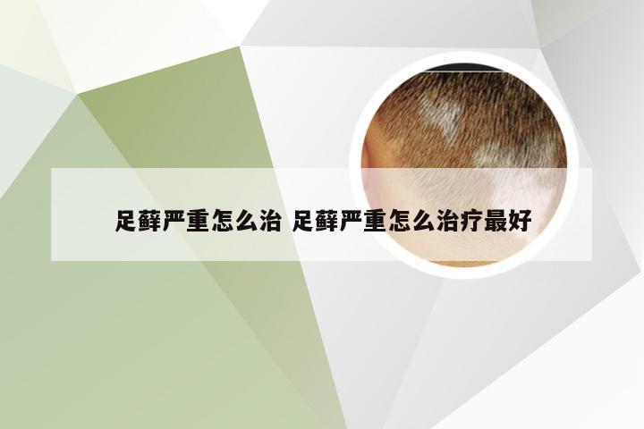 足藓严重怎么治 足藓严重怎么治疗最好