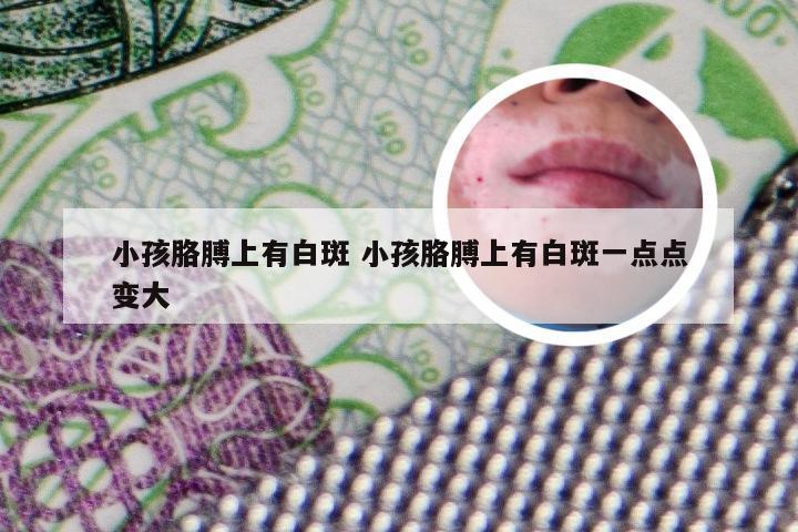 小孩胳膊上有白斑 小孩胳膊上有白斑一点点变大