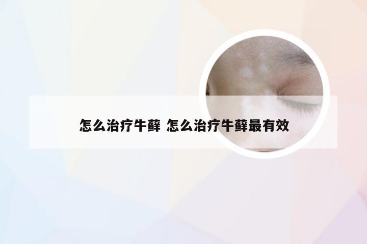 怎么治疗牛藓 怎么治疗牛藓最有效