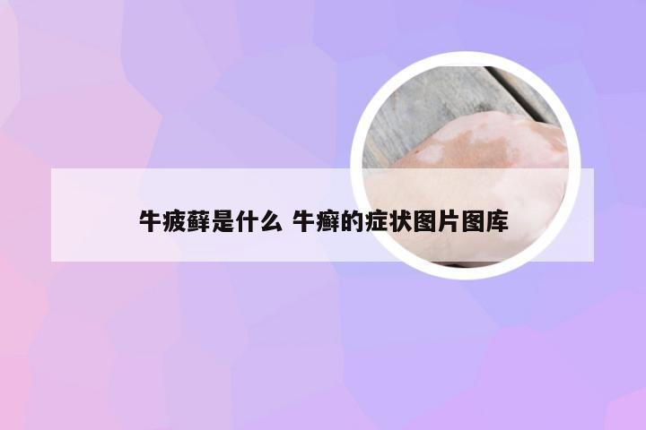 牛疲藓是什么 牛癣的症状图片图库