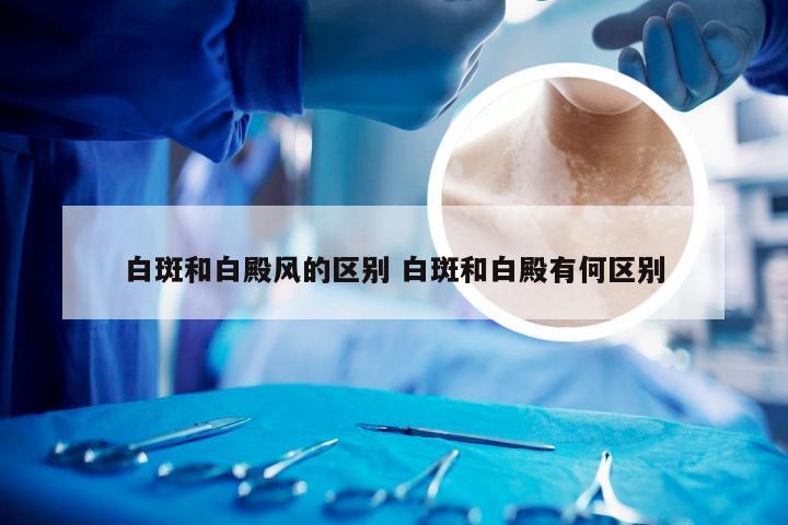 白斑和白殿风的区别 白斑和白殿有何区别