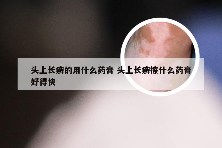 头上长癣的用什么药膏 头上长癣擦什么药膏好得快