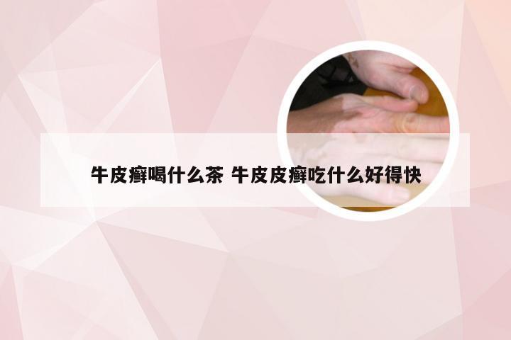 牛皮癣喝什么茶 牛皮皮癣吃什么好得快