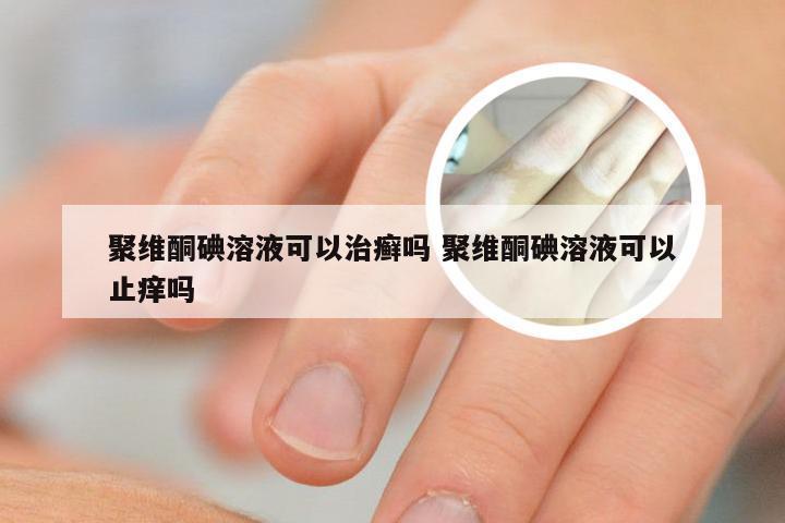 聚维酮碘溶液可以治癣吗 聚维酮碘溶液可以止痒吗