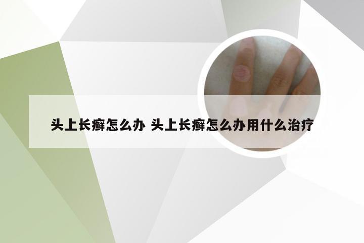 头上长癣怎么办 头上长癣怎么办用什么治疗