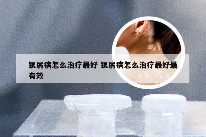 银屑病怎么治疗最好 银屑病怎么治疗最好最有效