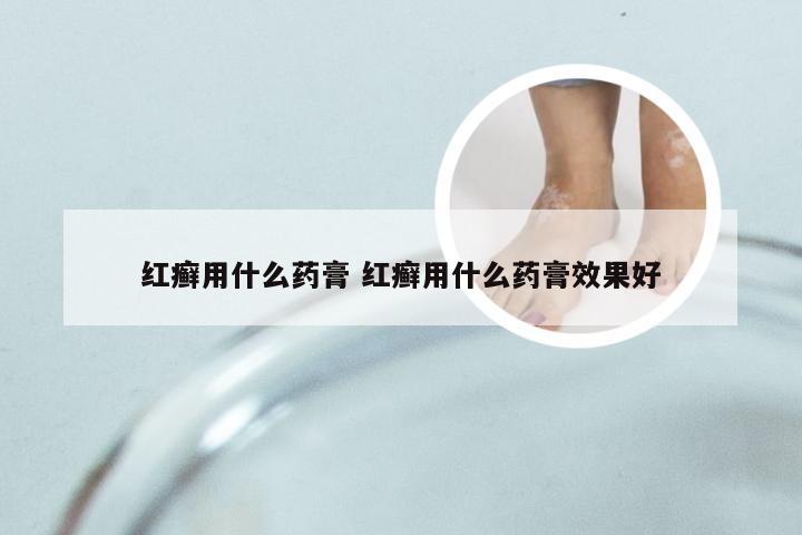 红癣用什么药膏 红癣用什么药膏效果好