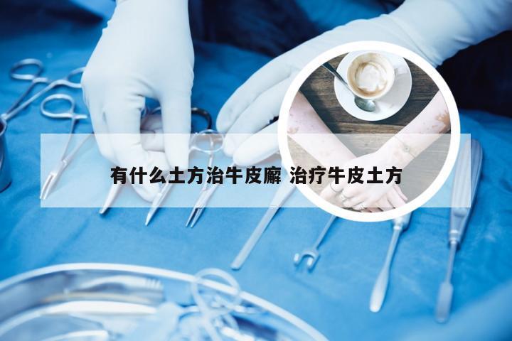 有什么土方治牛皮廨 治疗牛皮土方