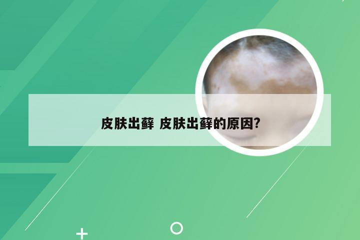 皮肤出藓 皮肤出藓的原因?