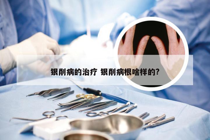 银削病的治疗 银削病根啥样的?