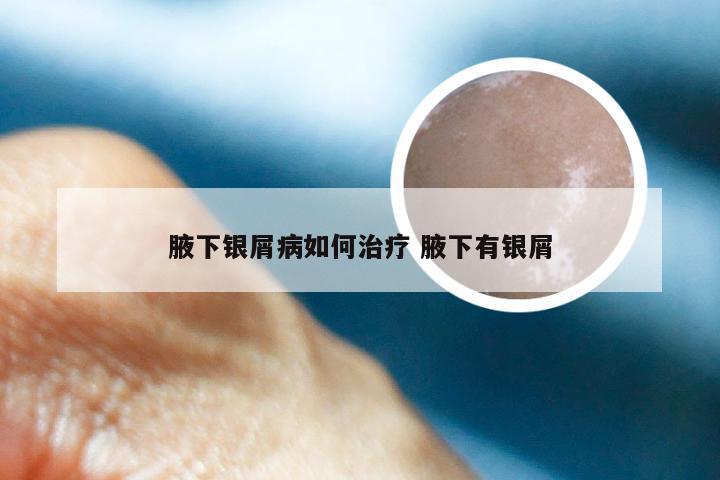 腋下银屑病如何治疗 腋下有银屑