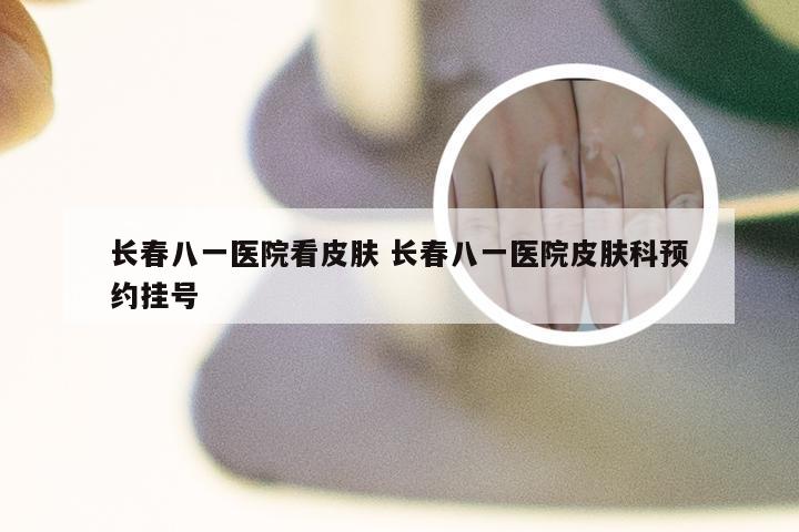 长春八一医院看皮肤 长春八一医院皮肤科预约挂号