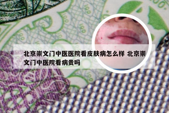 北京崇文门中医医院看皮肤病怎么样 北京崇文门中医院看病贵吗