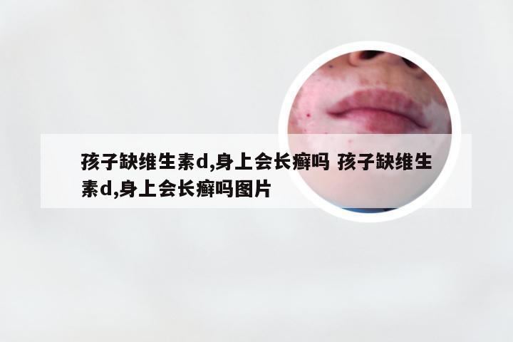 孩子缺维生素d,身上会长癣吗 孩子缺维生素d,身上会长癣吗图片