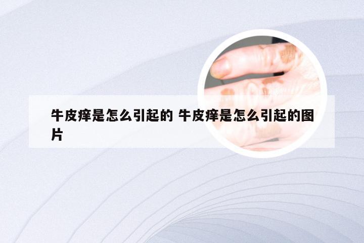 牛皮痒是怎么引起的 牛皮痒是怎么引起的图片