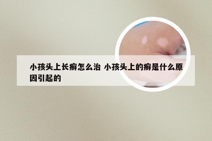 小孩头上长癣怎么治 小孩头上的癣是什么原因引起的