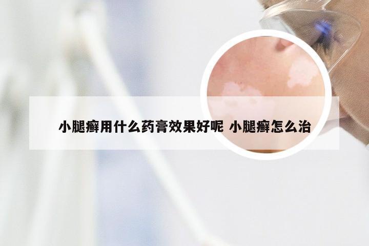 小腿癣用什么药膏效果好呢 小腿癣怎么治