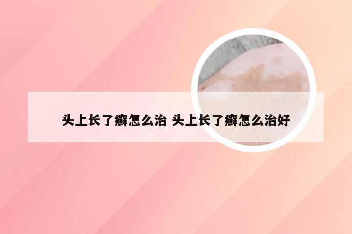 头上长了癣怎么治 头上长了癣怎么治好