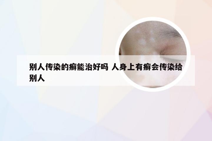 别人传染的癣能治好吗 人身上有癣会传染给别人