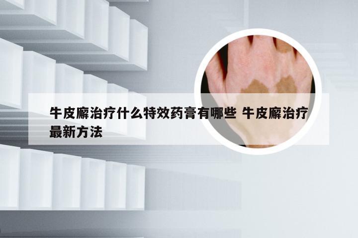 牛皮廨治疗什么特效药膏有哪些 牛皮廨治疗最新方法